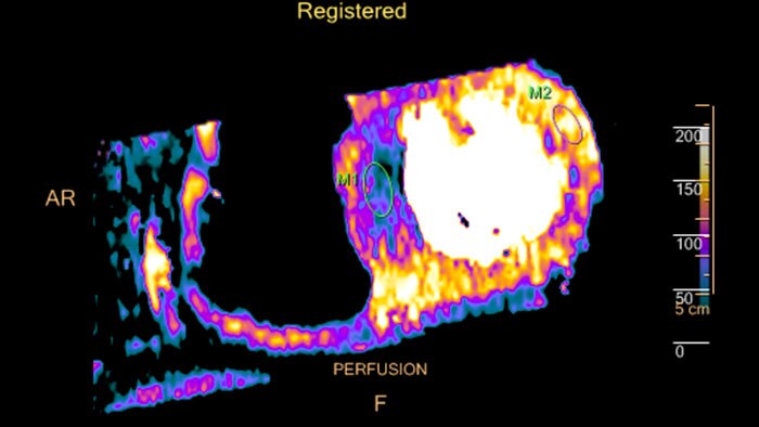 dynamic myocardial perfusion thumbnail