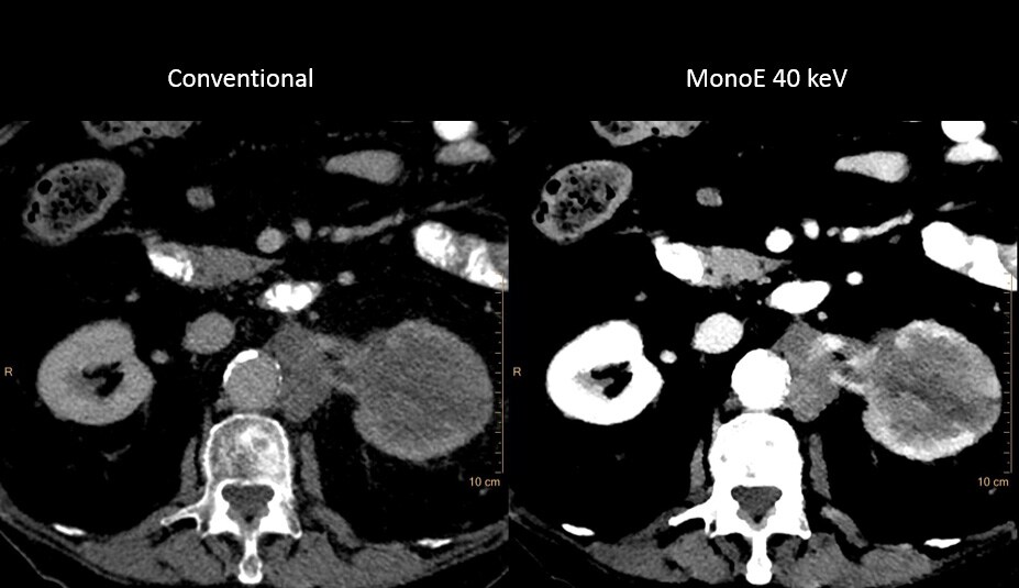 Conventional Scan Vs MonoE