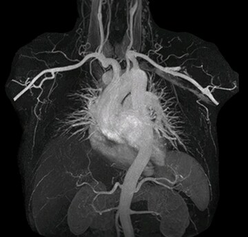 mDIXON MRA in chest