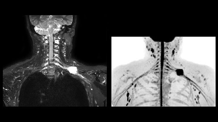 Nerve lesion MR