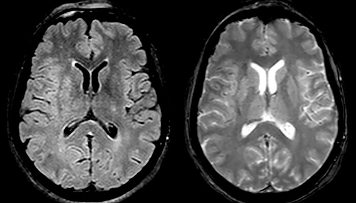 Acute ischemic stroke mca