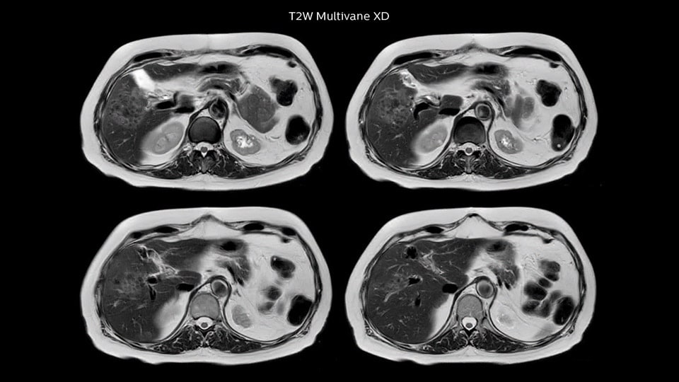 Bremen Case2 1 liver MRI 960px