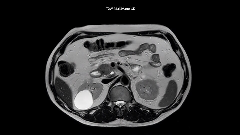 Bremen Case 1 Pancreas tumor 960px